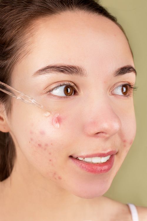 Cuidado de piel con imperfecciones — imagen ilustrativa